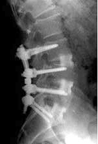 Synaptic Resources - Spinal Surgery IOM